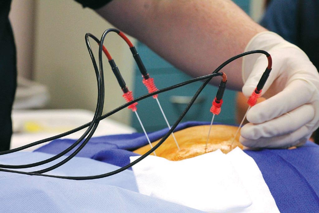  Radiofréquence pour le traitement interventionnel de la douleur
