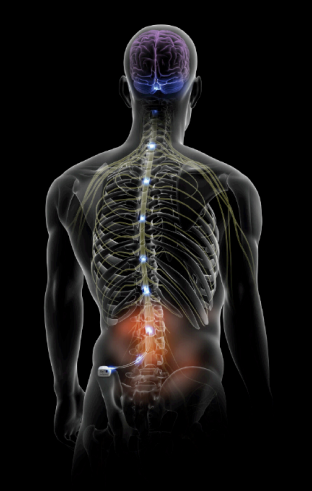 Neurochirurgie de la douleur